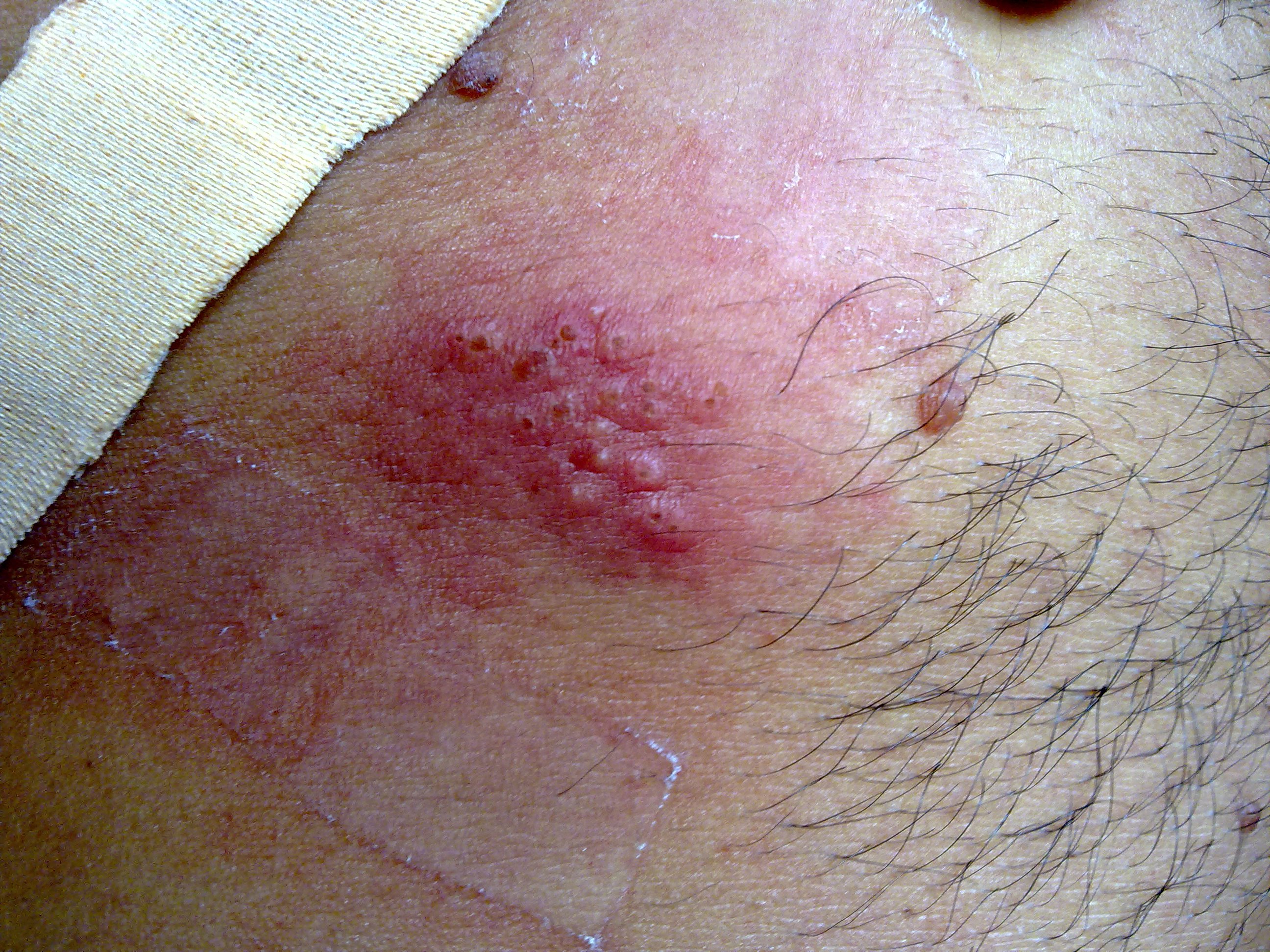 plaque rouge sur le corps qui brule plaque rouge sur le corps qui brule